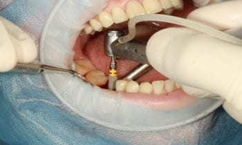 Dental Implants - Smileperfectors