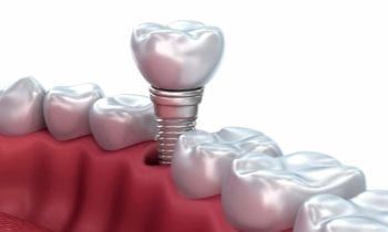 Sinlge tooth Implant - Smileperfectors