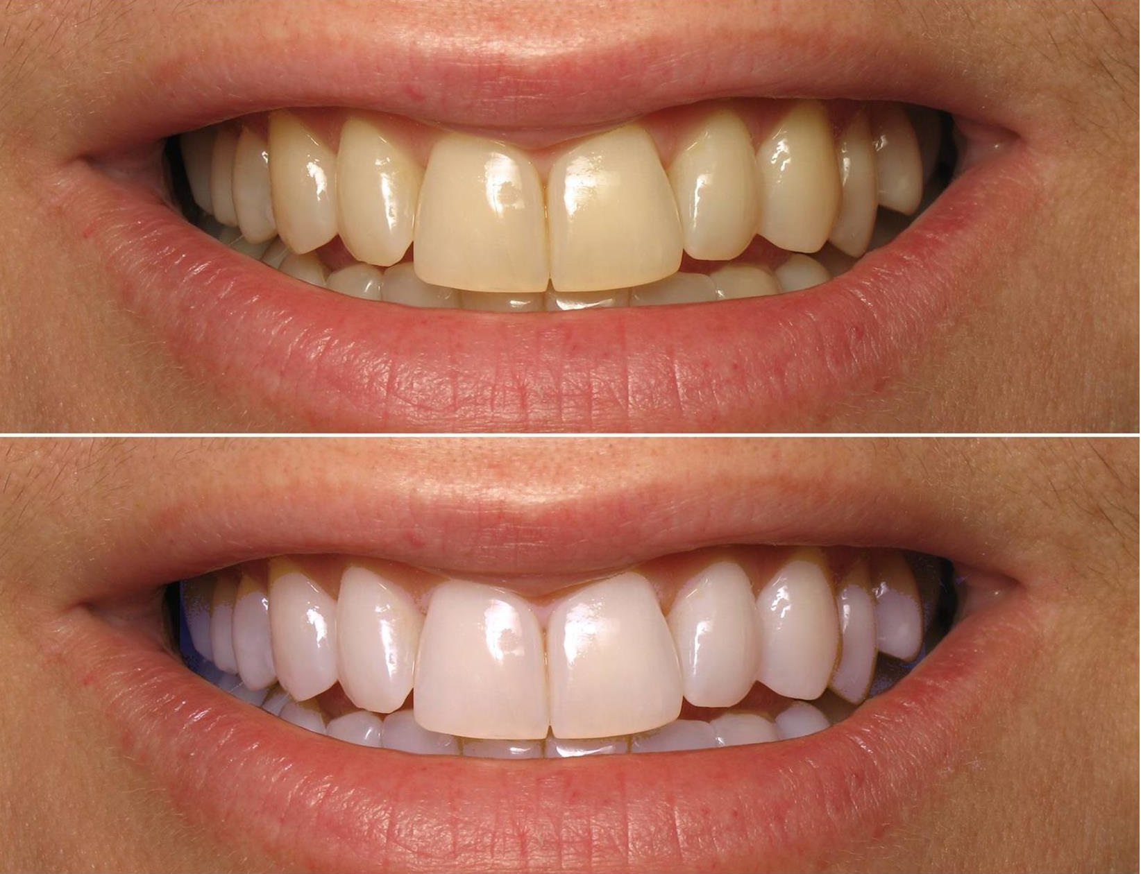 Do It Yourself Teeth Whitening Remedies To Make Your Teeth Whiter