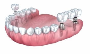 dental bridges and dental implants - Smileperfectors