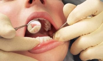 Root Canal - Smileperfectors