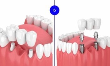 Dental Implants or Dental Bridges - Smileperfectors