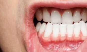 Gum Disease - Smileperfectors