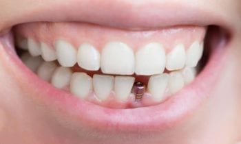 Dental Implants - Smileperfectors