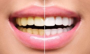 Teeth Whitening - Smileperfectors