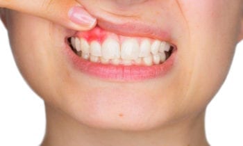 Gum Diseases - Smileperfectors