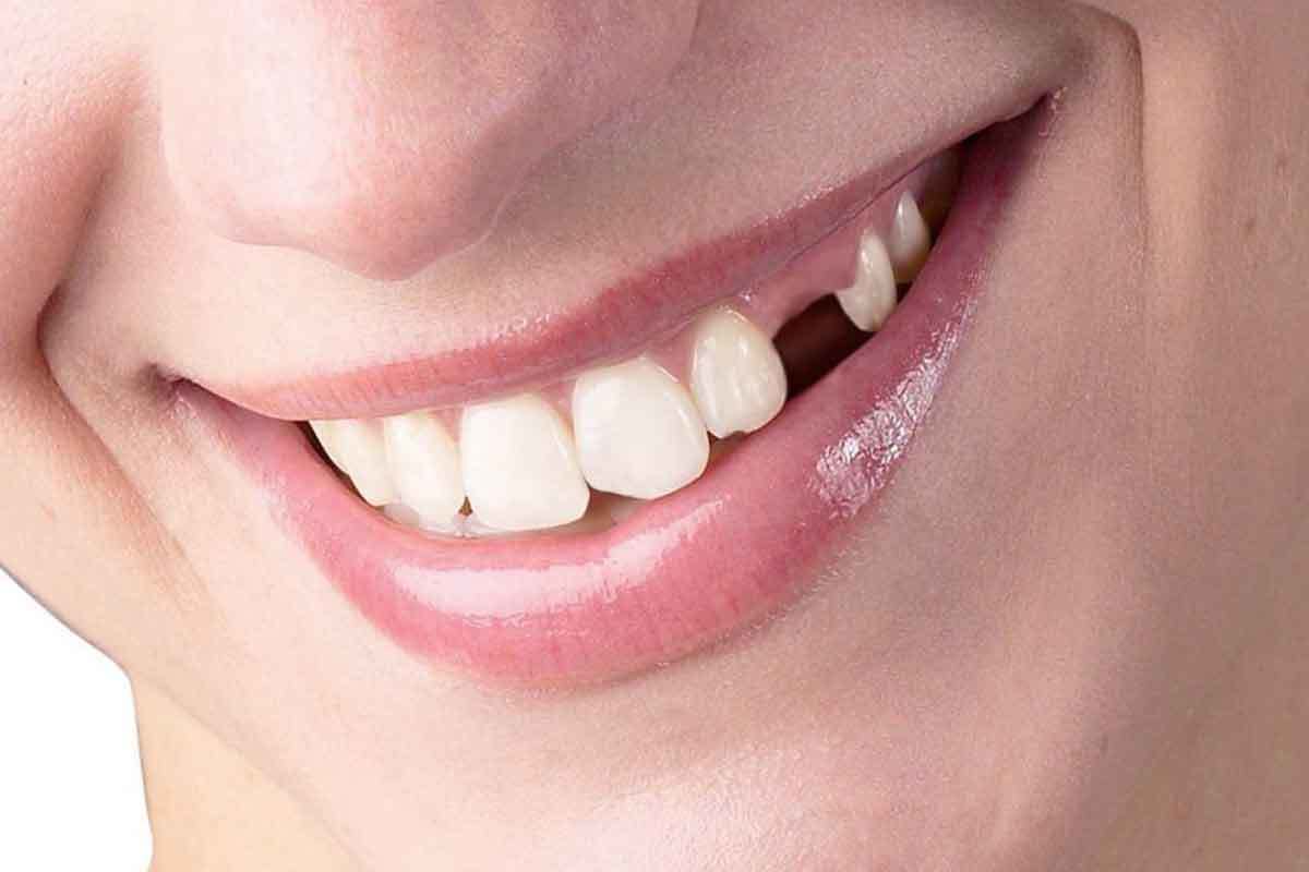 Need a LongTerm Solution for Your Missing Teeth? Try Need a LongTerm Solution for Your Missing Teeth? Try