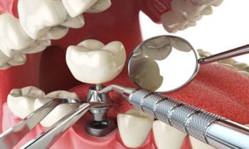 dental implant - Smileperfectors