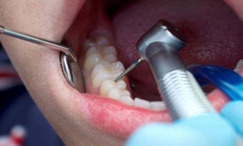 Root Canal Treatment - Smileperfectors