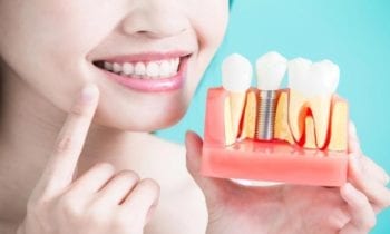 dental Implants - SmilePerfectors