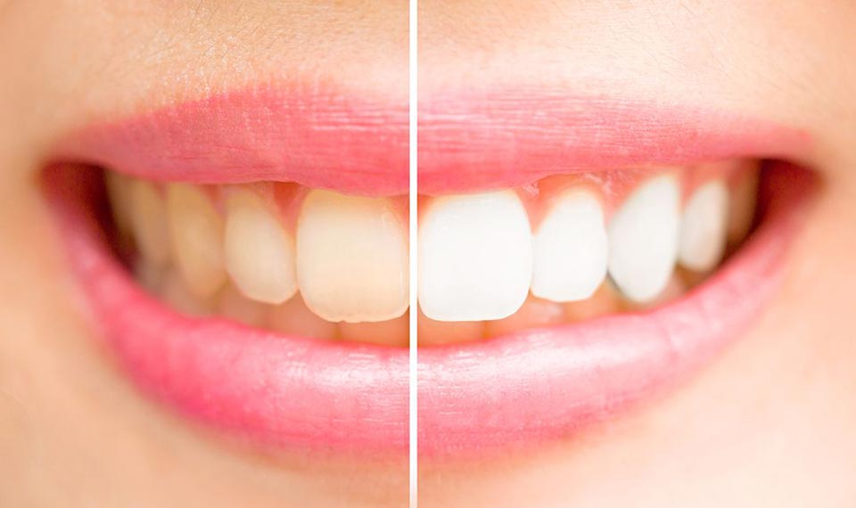 Visit SmilePerfectors for Advanced Zoom Teeth Whitening ...