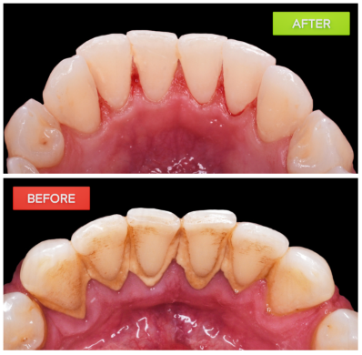 professional teeth cleaning before after