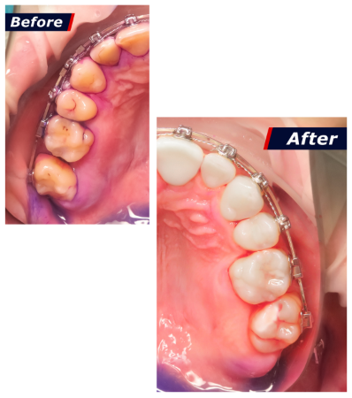Dental Hygienist before after