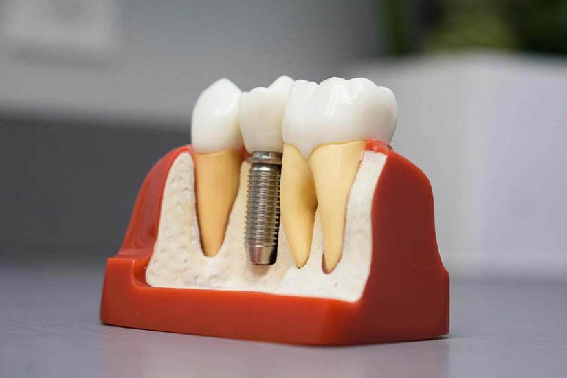 , What Kind Of Aftercare Is Expected For Dental Implant (A Complete Guide), Smile Perfectors
