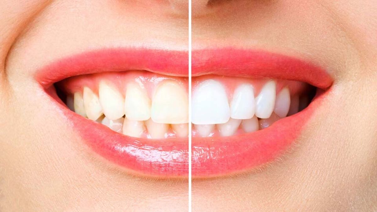 Teeth Whitening with Lemon, Baking Soda at Home - 6 Effective Remedies