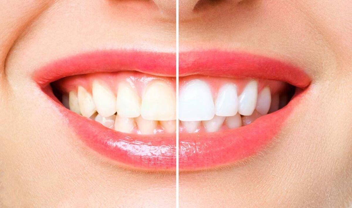 5 Quick and Effective At-Home Teeth Whitening Methods Applying Whitening Strips