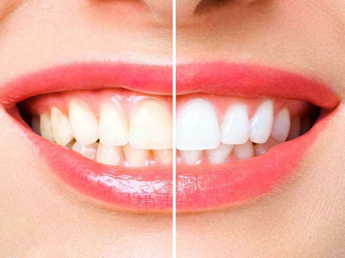 Teeth Whitening with Lemon, Baking Soda at Home - 6 Effective Remedies