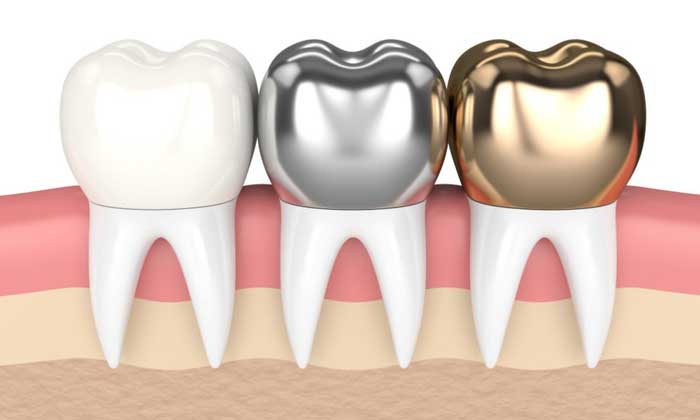Different types of dental crowns