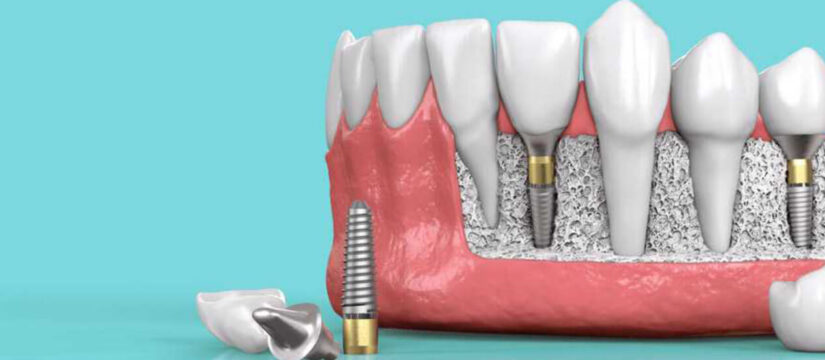 dental implants tysons corner, Smile Perfectors