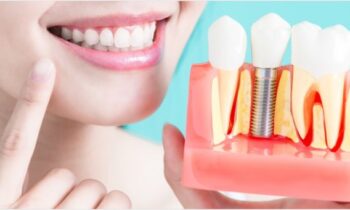 dental implants tysons corner