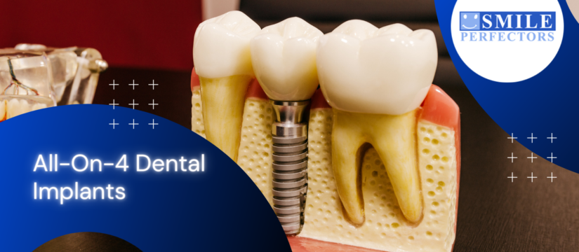 All-on-4 dental implants, Smile Perfectors