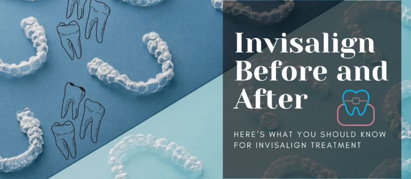 Invisalign Before and After, Smile Perfectors