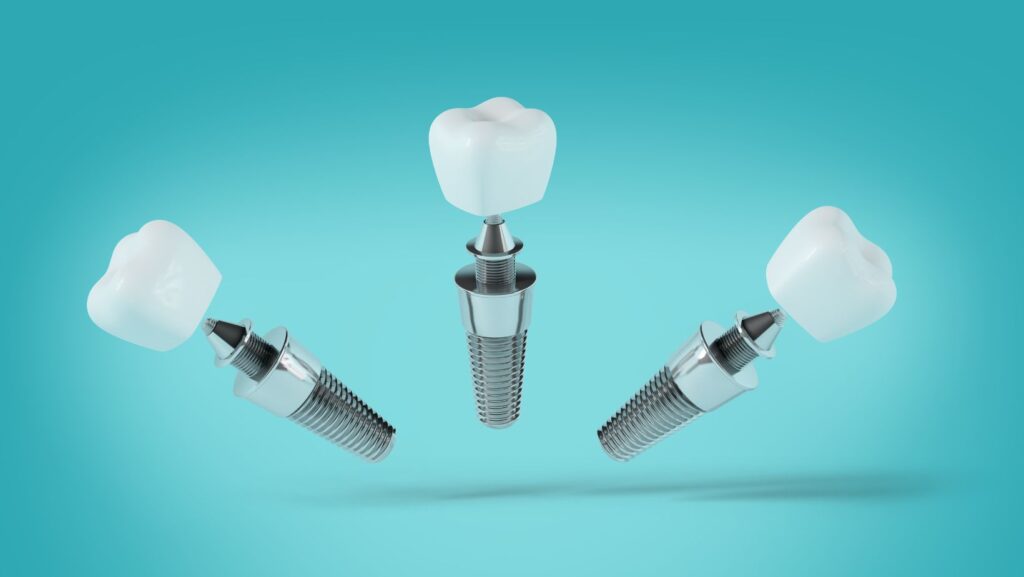 Dental Implants in Tysons Corner, Why Should You Consider Dental Implants in Tysons Corner?, Smile Perfectors
