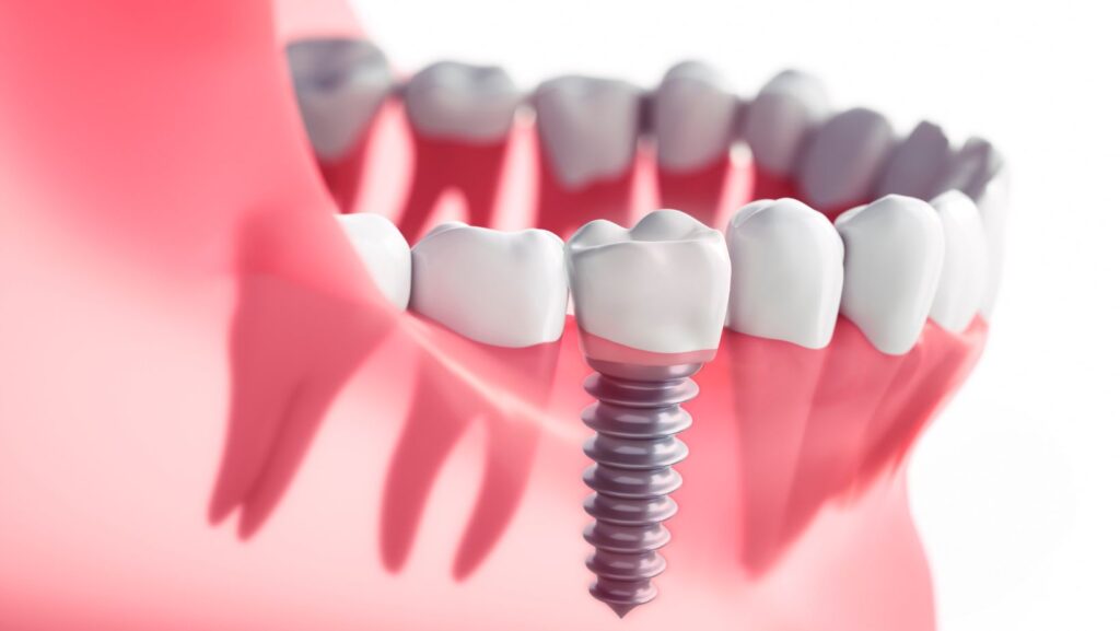 Dental Implants in Tysons Corner, Smile Perfectors