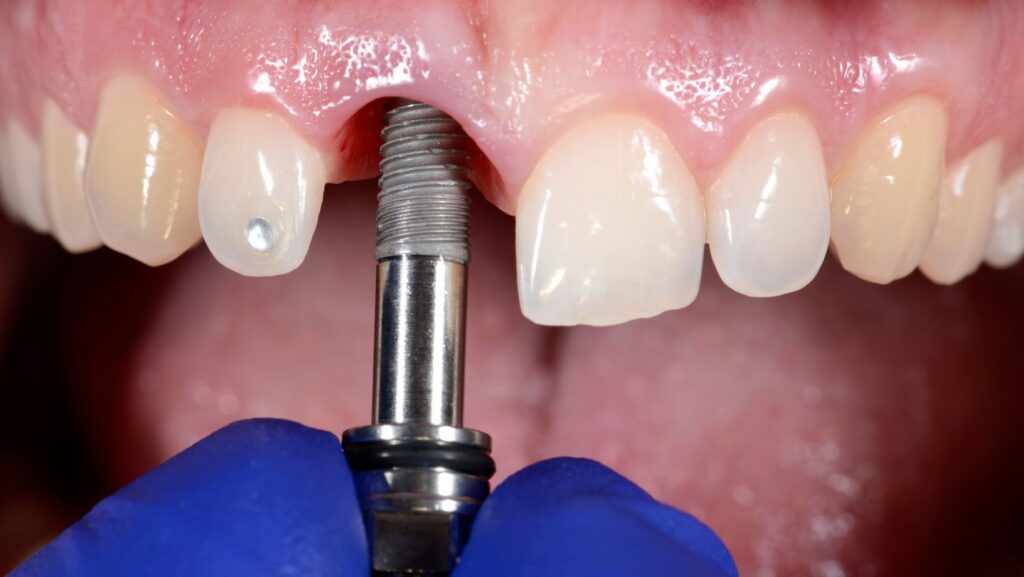 Dental Implants in Tysons Corner, Why Should You Consider Dental Implants in Tysons Corner?, Smile Perfectors