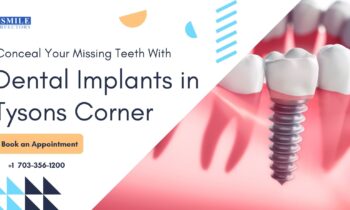 Dental Implants Tysons Corner