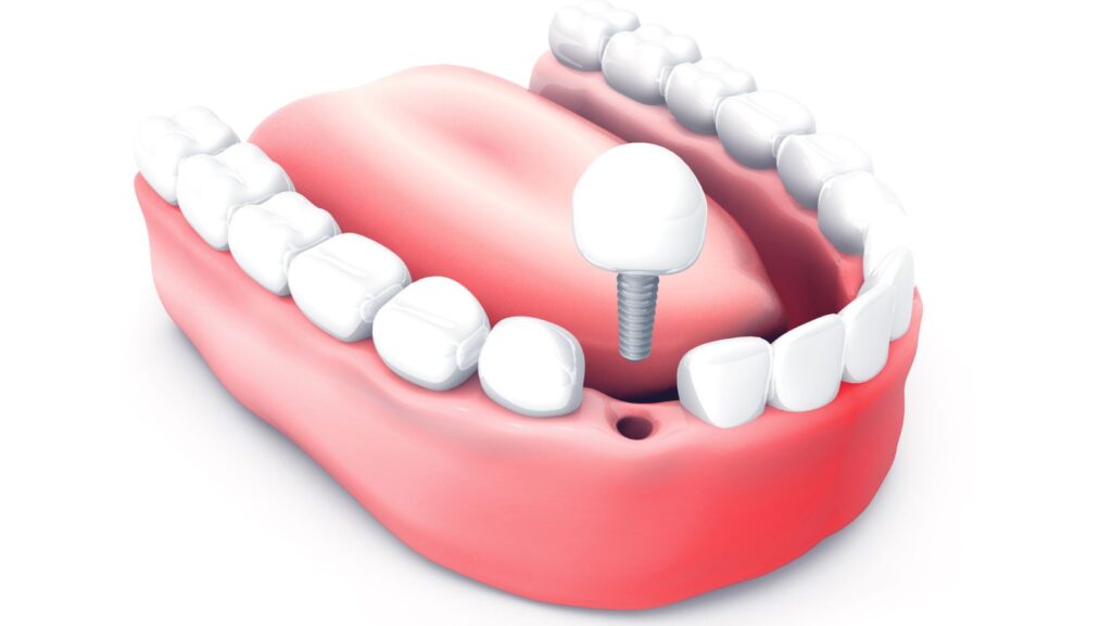 Dental Implants in Tysons Corner, Smile Perfectors