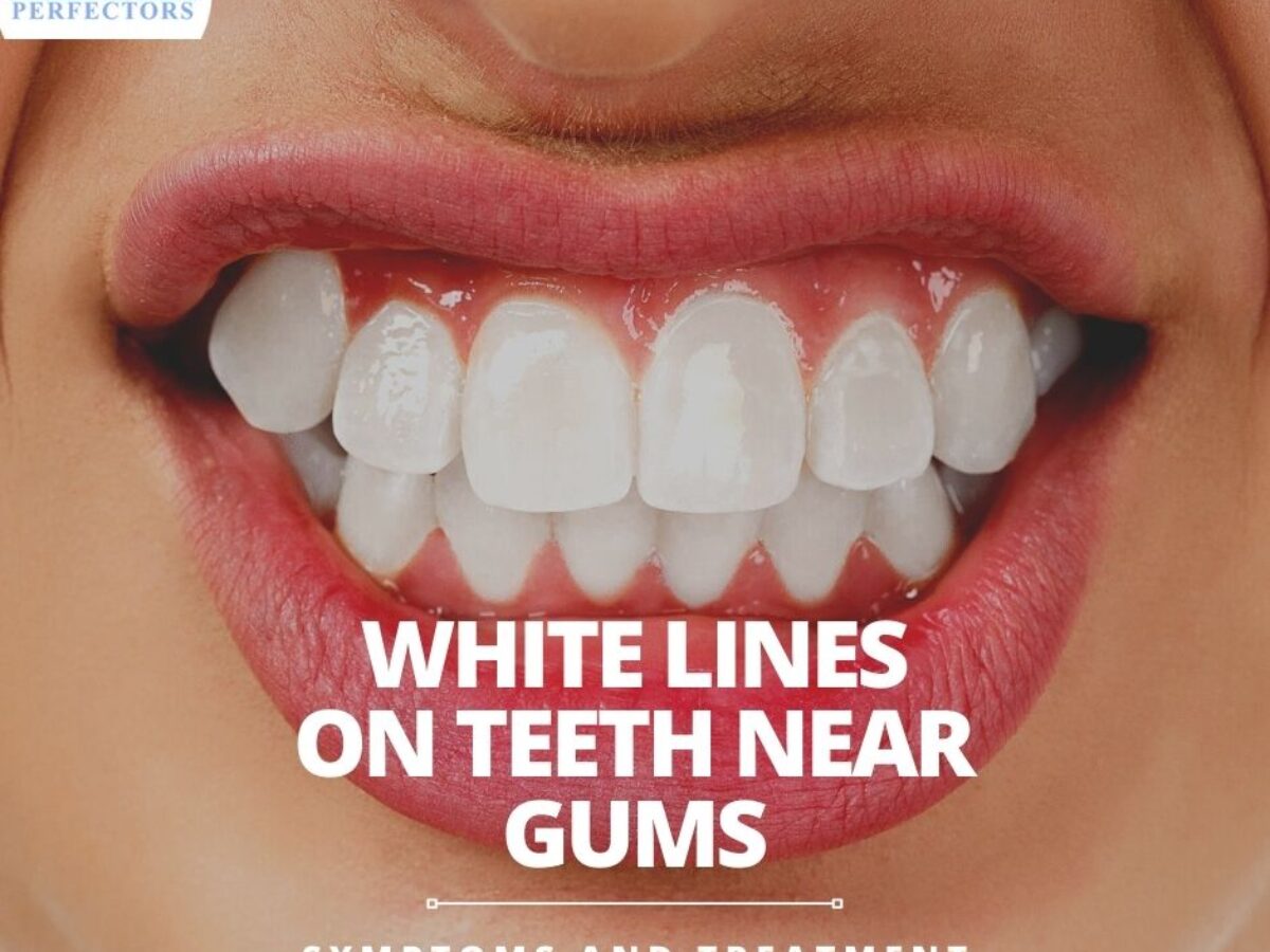 Teeth Craze Lines: Causes, Treatments & 6 Ways To Prevent It