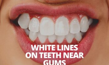 White Lines On Teeth Near Gums