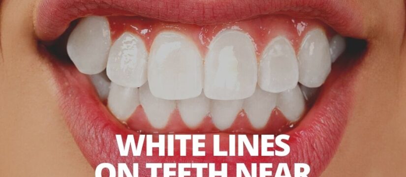 White Lines On Teeth Near Gums, Smile Perfectors