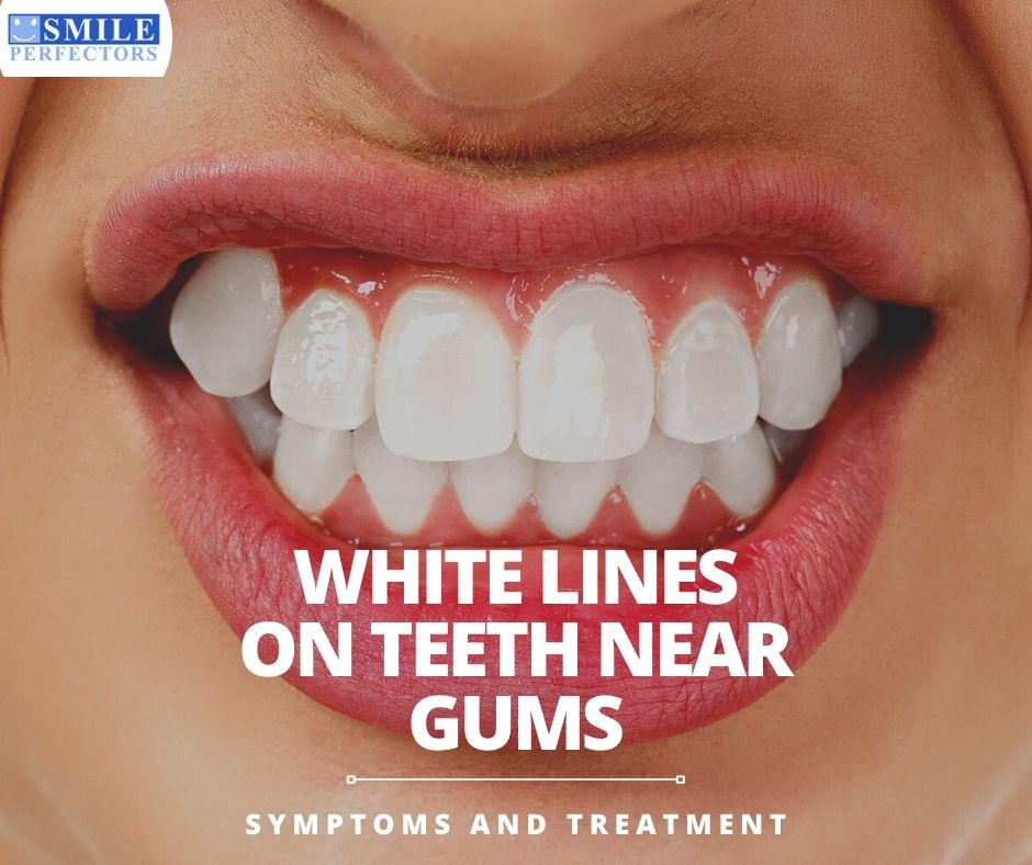 White Lines On Teeth Near Gums Symptoms And Treatment