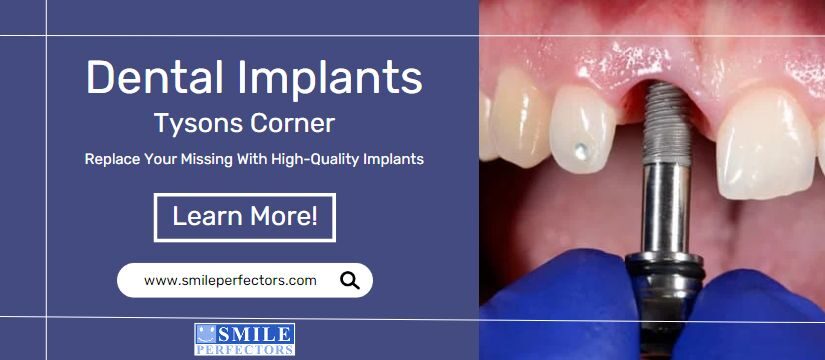 Dental Implants Tysons Corner, Smile Perfectors