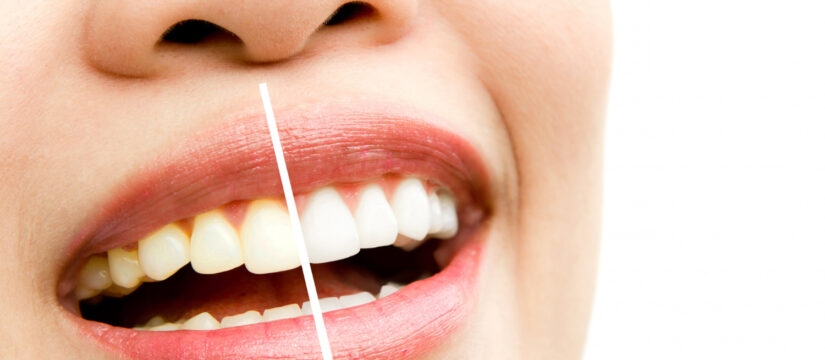 How Long Does It Take To Whiten Teeth, Smile Perfectors