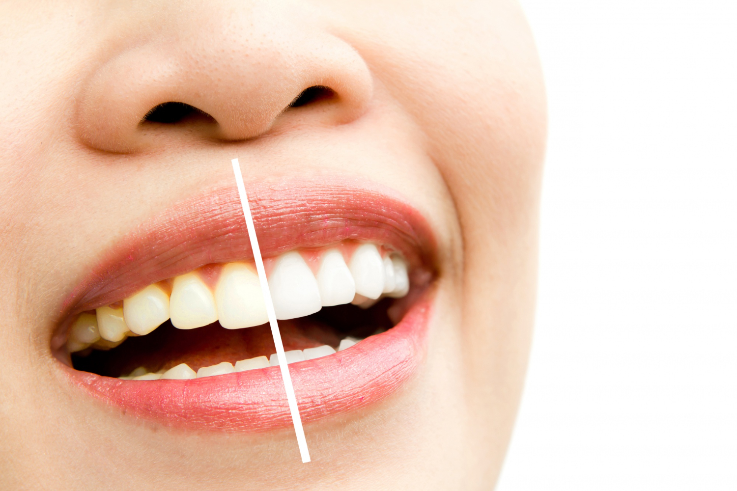 How Long Does It Take To Whiten Teeth? Smile Perfectors